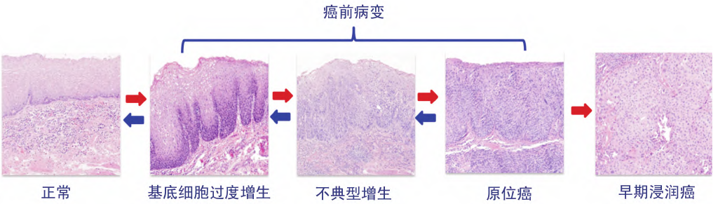 更适合食管癌筛查和早期诊断的方法来啦 更适合食管癌筛查和早期诊断的方法来啦
